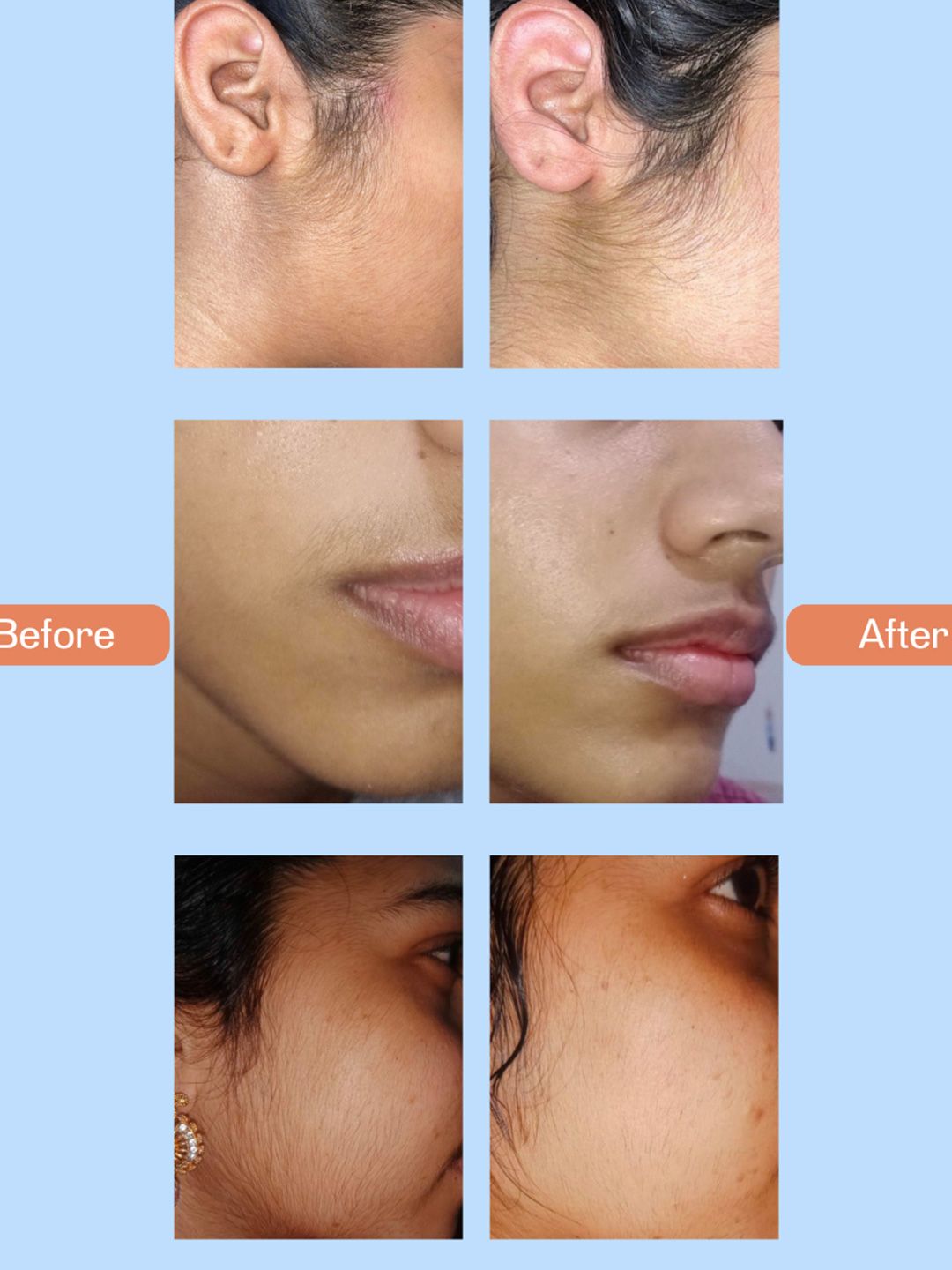 Buy The Hade Nofuzz Permanent Facial Hair Removal Pack - 45 g