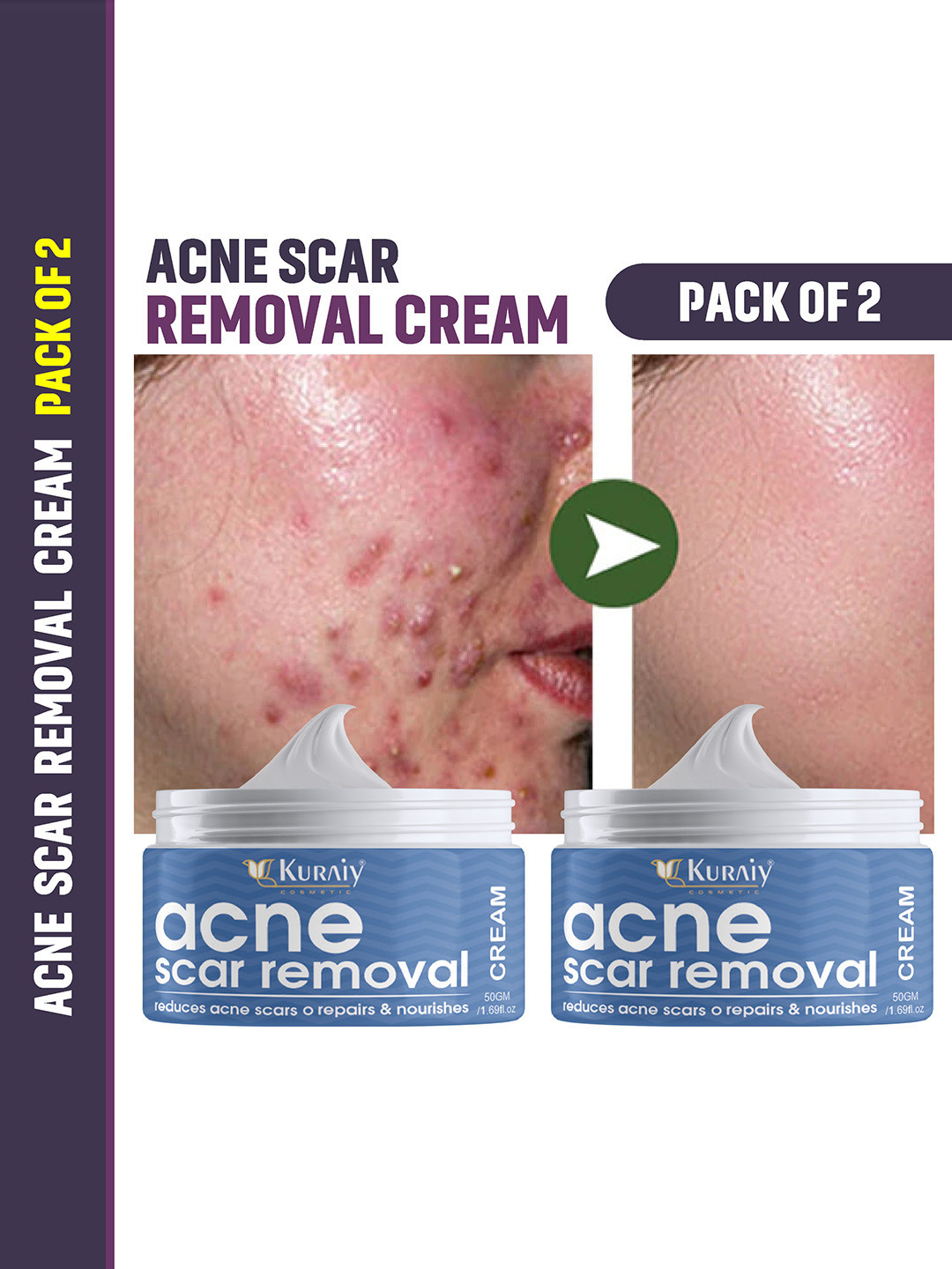 KURAIY Set Of 2 Acne Removal Cream