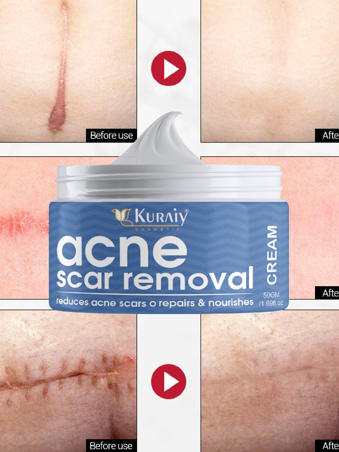 

KURAIY Acne Scar & Spot Removal Cream - 50gm, White
